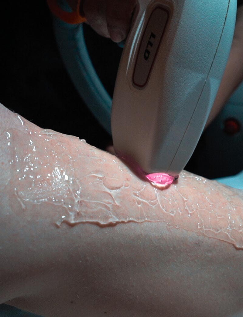 Epilation laser au Patio Spa à Beauvais / Allonne